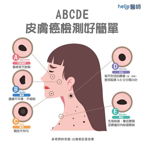 為什麼身上會有痣|痣形成的原因？痣長毛、痣變多變大是痣病變？5招判。